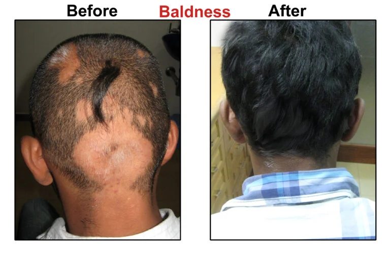 Baldness Before & After