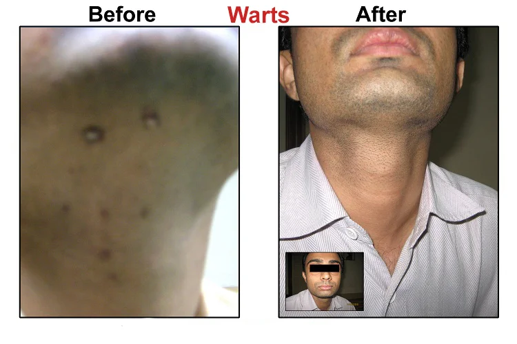 Warts Before After
