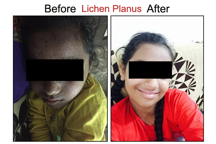 Lichen Planus Before After On Face