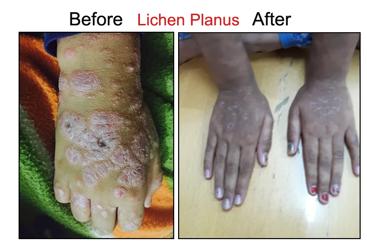 Lichen Planus Before After On Hand
