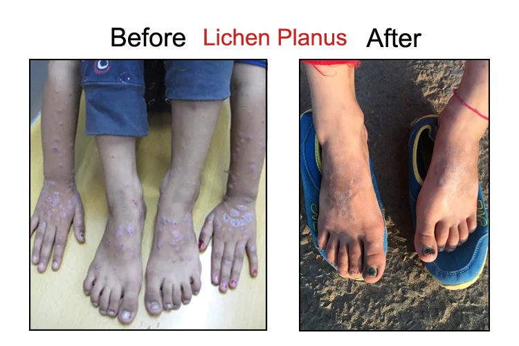 Lichen Planus Before After On Leg